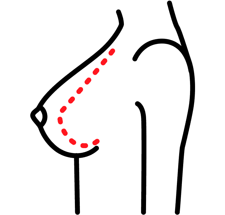 Illustrasjon av brystreduksjon i profil