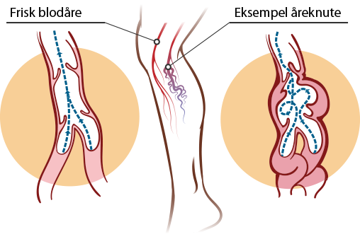 Illustrasjon på åreknute