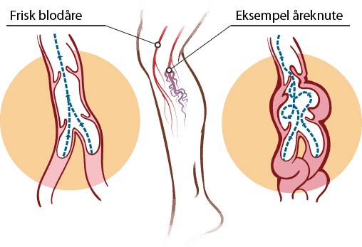 Illustrasjon på åreknute