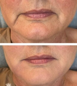 Bilde fra før og etter Restylane behandling