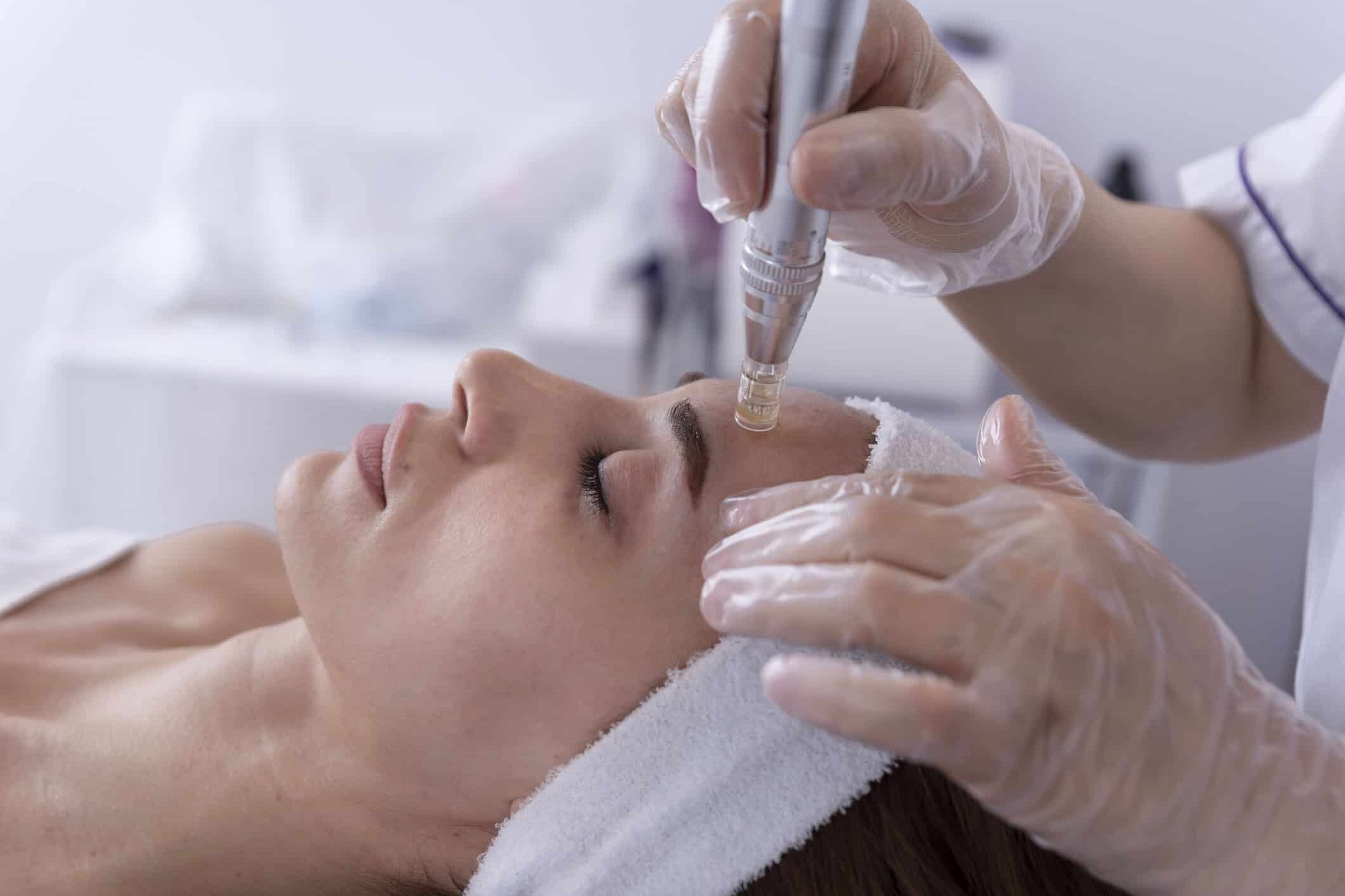 Microneedling med Dermapen for bedre hudstruktur i Drammen