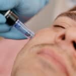 Bilde av en mann som får dermapen behandling